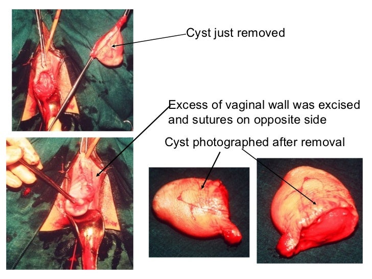surgery for vaginal cysts Surgery for vaginal cysts